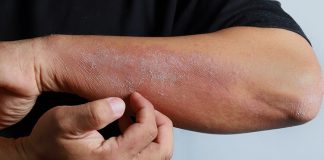 Egzama, yaygın olarak görülen kronik bir cilt hastalığı olup, milyonlarca insanı etkilemektedir. Tıp dilinde “atopik dermatit” olarak da adlandırılan bu durum, özellikle bağışıklık sisteminin aşırı reaksiyonu ile ilişkilidir. Cilt bariyerinin zayıflaması, çevresel etkenlere karşı hassasiyetin artması ve genetik yatkınlık egzamanın gelişiminde başlıca faktörlerdendir. Ancak en belirgin belirtisi kaşıntı, kuruluk ve kızarıklıkla kendini gösteren bir iltihaplanma sürecidir. Bu yazıda egzamanın ne olduğu, neden kaşıntıya yol açtığı ve Türkiye’deki yaygınlığı ele alınacaktır. Konulu bir haber görseli.