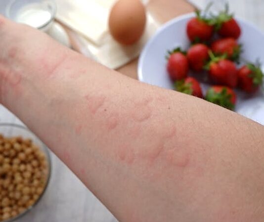 Günümüzde birçok kişi, gıda intoleransı ya da gıda alerjisi gibi sağlık sorunlarıyla karşı karşıya kalabiliyor. Hem gıda intoleransı hem de gıda alerjisi, tüketilen gıdalara karşı vücudun olumsuz reaksiyonlar vermesiyle kendini gösterir. Ancak, bu iki durum arasında önemli farklar bulunmaktadır. Gıda intoleransı ve alerjisi, belirtilerinin benzer olması nedeniyle sıklıkla karıştırılsa da, vücudun her iki duruma verdiği tepki farklı mekanizmalarla işler. Bu yazıda, gıda intoleransı ve gıda alerjisi arasındaki temel farkları detaylı bir şekilde ele alacağız. Konulu bir haber görseli.