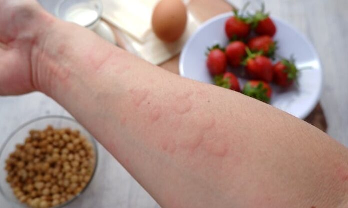 Günümüzde birçok kişi, gıda intoleransı ya da gıda alerjisi gibi sağlık sorunlarıyla karşı karşıya kalabiliyor. Hem gıda intoleransı hem de gıda alerjisi, tüketilen gıdalara karşı vücudun olumsuz reaksiyonlar vermesiyle kendini gösterir. Ancak, bu iki durum arasında önemli farklar bulunmaktadır. Gıda intoleransı ve alerjisi, belirtilerinin benzer olması nedeniyle sıklıkla karıştırılsa da, vücudun her iki duruma verdiği tepki farklı mekanizmalarla işler. Bu yazıda, gıda intoleransı ve gıda alerjisi arasındaki temel farkları detaylı bir şekilde ele alacağız. Konulu bir haber görseli.