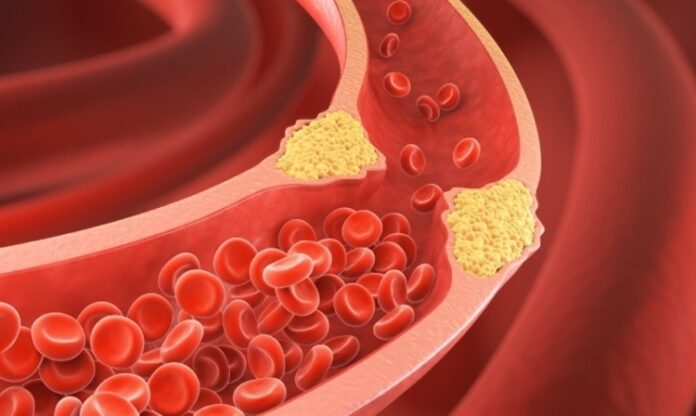 Kolesterol, vücutta bulunan ve vücudun birçok önemli işlevini sürdürebilmesi için gerekli olan bir yağ molekülüdür. Ancak, kolesterolün türü ve seviyeleri, sağlığımız üzerinde büyük bir etkiye sahiptir. Kolesterol seviyelerini değerlendiren önemli terimler arasında HDL ve LDL kolesterol yer alır. Bu iki terim, kalp sağlığı açısından kritik rol oynayan ve doktorların hastalarının kolesterol seviyelerini değerlendirmede kullandığı başlıca göstergelerdir. Bu yazıda, HDL ve LDL kolesterolün ne anlama geldiğini, bunların vücut üzerindeki etkilerini ve nasıl yönetilebileceğini inceleyeceğiz. Konulu bir haber görseli.