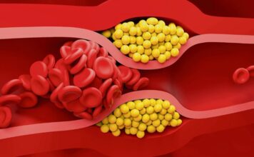 Kolesterol Nedir ve Hangi Değerler Risk Taşır Kalp ve damar sağlığını doğrudan etkileyen konular arasında ilk sıralarda yer alan kolesterol, çoğu zaman kötü bir şeymiş gibi algılansa da aslında vücudun temel yapı taşlarından biridir. Hücre zarlarının yapısında bulunan, hormon üretiminde görev alan ve D vitamini sentezine yardımcı olan bu yağ benzeri madde, yalnızca gıdalarla alınmaz; karaciğer tarafından da üretilir. Ancak vücutta belli seviyelerin üzerine çıktığında ciddi sağlık problemlerine yol açabilir. Bu nedenle kolesterolün ne olduğu, neden yükseldiği ve hangi değerlerin tehlikeli kabul edildiği, toplum sağlığı açısından hayati bir önem taşır. Konulu bir haber görseli.