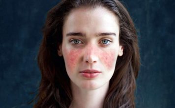 Lupus, bağışıklık sisteminin oluşturduğu otoantikorlar aracılığıyla çeşitli organlarda iltihabi reaksiyonlar başlatır. Bu otoantikorlar, vücudun kendi hücre bileşenlerine bağlanarak bağışıklık sistemini tetikler. Bu süreçte özellikle böbreklerde “lupus nefriti” olarak bilinen ciddi bir enflamasyon şekli gelişebilir.