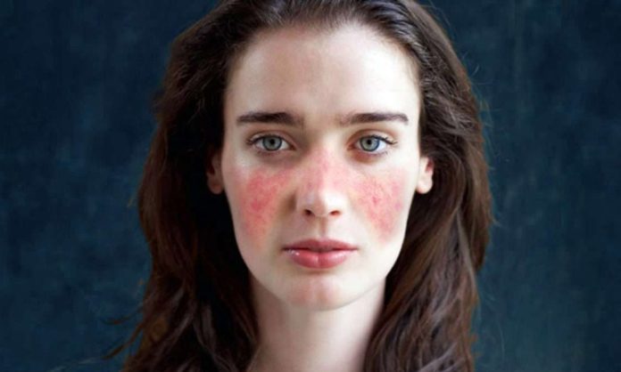 Lupus, bağışıklık sisteminin vücudun kendi dokularına karşı yanlışlıkla savaş açtığı otoimmün bir hastalık olarak bilinir. Bu hastalık özellikle genç kadınlarda görülür ve tüm dünyada milyonlarca insanı etkiler. Bağışıklık sistemi, normalde vücuda dışarıdan giren bakteri, virüs veya zararlı mikroorganizmalara karşı bir savunma mekanizması olarak çalışırken, lupus hastalığında bu sistem kendi organlarını hedef alır. Bu durum çeşitli organ ve dokularda iltihaplanma ve hasara neden olur. Konulu bir haber görseli