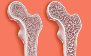 Osteoporoz Nedir ve Neden Kadınlarda Daha Yaygındır Sessiz ilerleyen ve genellikle kırıklarla fark edilen osteoporoz, kemiklerin yoğunluğunu kaybederek zayıflaması ve kırılgan hale gelmesiyle karakterize edilen bir kemik hastalığıdır. Özellikle ileri yaşta görülen bu hastalık, kadınlarda erkeklere oranla çok daha sık rastlanır. Kadınların yaşam boyu kemik sağlığını etkileyen biyolojik ve hormonal faktörleri, osteoporozun gelişiminde belirleyici rol oynar. Genellikle belirti vermeyen bu hastalık, fark edilmediğinde ciddi sağlık problemlerine yol açabilir. Bu nedenle osteoporoz hakkında bilinçlenmek ve erken önlem almak, bireysel sağlığın korunmasında oldukça önemlidir. Konulu bir haber görseli.