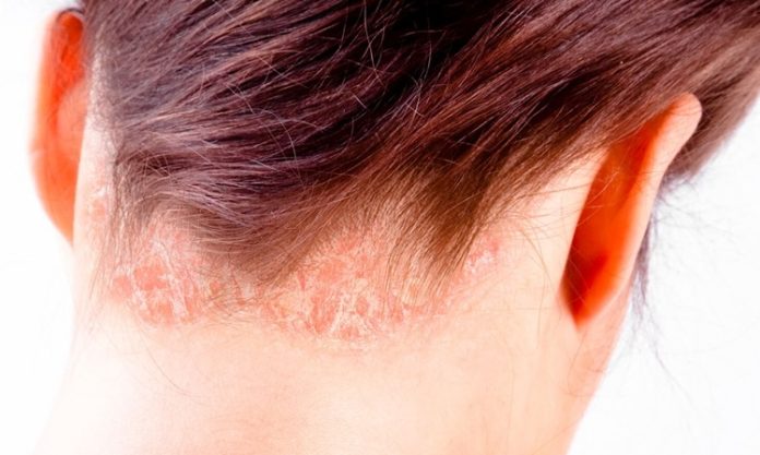 Sedef hastalığı, tıbbi adıyla psoriasis, bağışıklık sisteminin yanlış sinyaller göndermesi sonucu deride meydana gelen kronik ve iltihaplı bir cilt hastalığıdır. Her yaş grubunda görülebilmekle birlikte genellikle genç erişkinlik döneminde ortaya çıkar. Toplumun yaklaşık %2 ila %3’lük bir kesimini etkileyen bu hastalık, kişiden kişiye farklılık gösteren klinik belirtilerle seyredebilir. Ancak pek çok hasta ve hasta yakını, en çok 