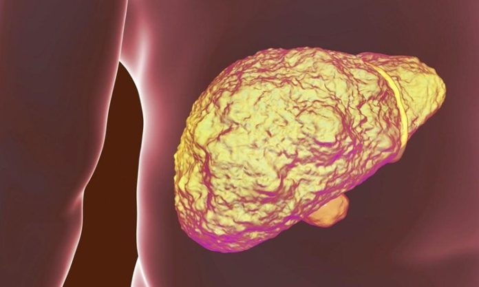 Siroz, karaciğerin ilerleyici ve geri dönüşü olmayan bir hastalığıdır. Bu hastalıkta, karaciğer hücreleri yavaş yavaş hasar görür, iltihaplanır ve bu hücrelerin yerini bağ dokusu alır. Hasar gören karaciğer dokusu, işlevini yerine getiremez hale gelir ve zamanla organın genel yapısı bozulur. Siroz hastalığı, genellikle uzun süreli karaciğer hasarı sonucu gelişir ve pek çok ciddi sağlık sorununa yol açabilir. Dünya genelinde milyonlarca insanın yaşam kalitesini etkileyen bu durum, erken tanı ve tedavi ile yavaşlatılabilir ancak tamamen iyileştirilemez. Konulu bir haber görseli.