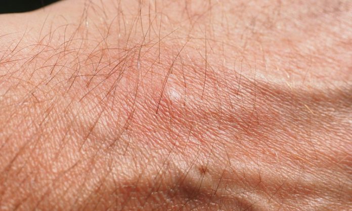 Uyuz hastalığı, insan cildinde yoğun kaşıntıya neden olan bulaşıcı bir deri enfeksiyonudur. Sarcoptes scabiei adlı mikroskobik bir akarın cilde yerleşmesiyle ortaya çıkan bu hastalık, özellikle kalabalık ortamlarda hızla yayılabilir. Akarın deriye girerek tüneller açması sonucu oluşan reaksiyonlar, şiddetli kaşıntı ve döküntü gibi belirtilerle kendini gösterir. Uyuz, sadece fiziksel rahatsızlık vermekle kalmaz, aynı zamanda sosyal ve psikolojik etkiler de yaratabilir. Bu nedenle uyuz hastalığı hakkında bilinçli olmak, erken teşhis ve etkili tedavi için oldukça önemlidir. Konulu bir haber görseli.