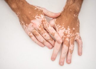 Vitiligo Nedir Ciltteki Beyaz Lekeler Ne Anlama Gelir Vitiligo hastalarında görülen beyaz lekeler, cilt yüzeyinde pigmentin kaybolduğu alanları ifade eder. Bu lekeler simetrik bir dağılım gösterebilir ya da vücudun yalnızca belirli bölgelerinde sınırlı kalabilir.