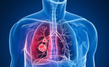 Zatürre, akciğerlerin iltihaplanması sonucu meydana gelen ve genellikle bakteri, virüs ya da mantar enfeksiyonları tarafından tetiklenen ciddi bir solunum yolu hastalığıdır. Her yaş grubunu etkileyebilmesine rağmen, yaşlı bireylerde zatürre daha ölümcül sonuçlar doğurabilir. Bunun arkasında, yaşın ilerlemesiyle birlikte bağışıklık sisteminin zayıflaması ve diğer kronik hastalıkların etkisi bulunmaktadır. Ayrıca yaşlıların vücutları, hastalıklara karşı daha az dirençli olduğundan, zatürre gibi ciddi hastalıkların tedavi edilmesi daha zor hale gelir. Konulu bir haber görseli.