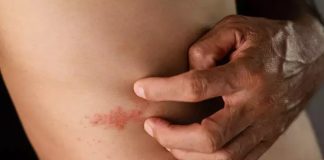 Zona hastalığı, halk arasında “gece yanığı” olarak da bilinir ve genellikle su çiçeği geçirmiş bireylerde yıllar sonra ortaya çıkabilir. Zona, sinir hücrelerinde gizlenen Varicella Zoster virüsünün yeniden aktifleşmesiyle meydana gelir. Bu durum, ciltte ağrılı döküntülerle kendini gösterse de, hastalığın en dikkat çeken yönü sinir sisteminde yarattığı kalıcı etkiler olabilir. Bu yazıda, zonanın neden olduğu sinirsel etkiler ve kalıcı ağrı potansiyeli üzerine derinlemesine bir inceleme sunulacaktır. Konulu bir haber görseli.